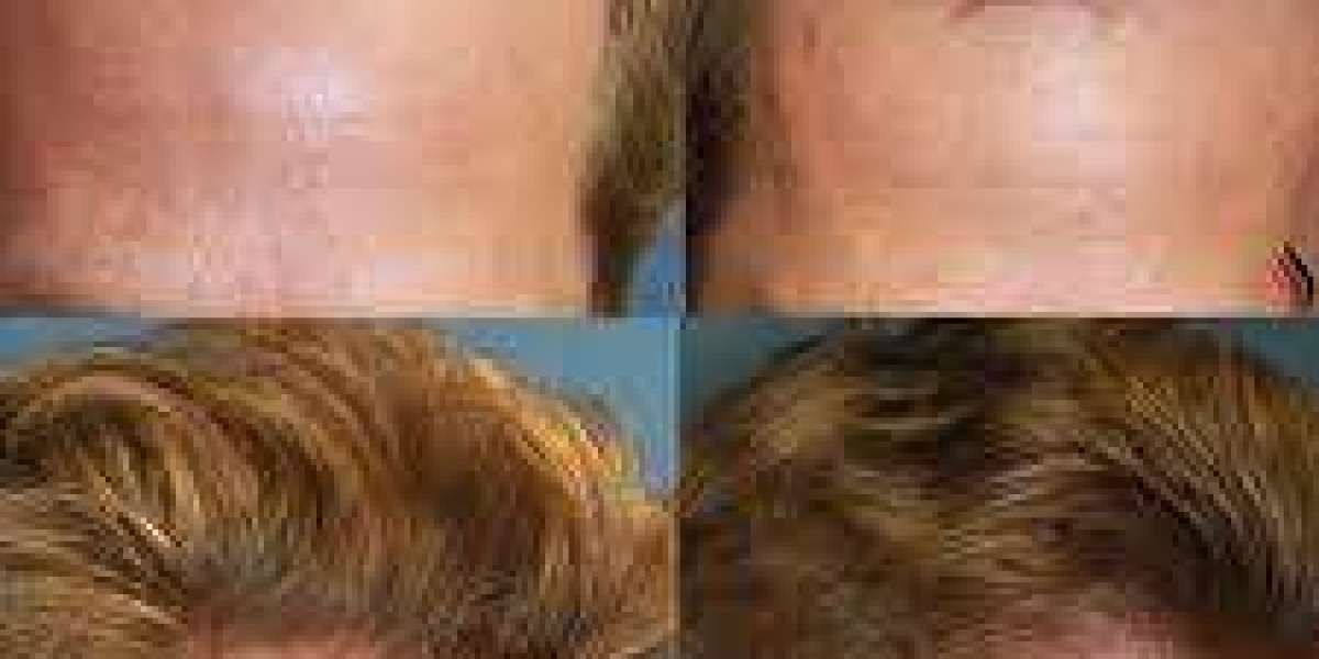 Hair Transplant in Beverly Hills: Advanced Techniques for Natural, Permanent Results